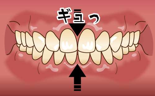 クレンチング（食いしばり）