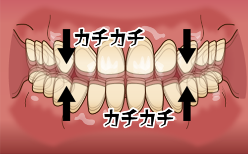 タッピング（歯をかちかちとかみ合わせる）