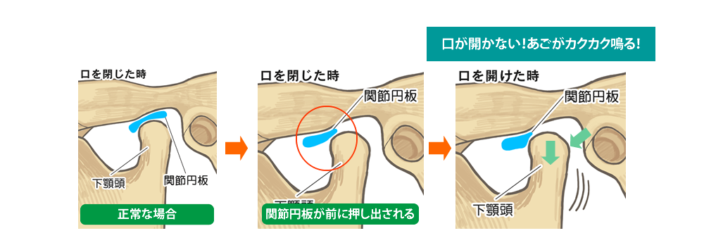 顎関節まわりの異常